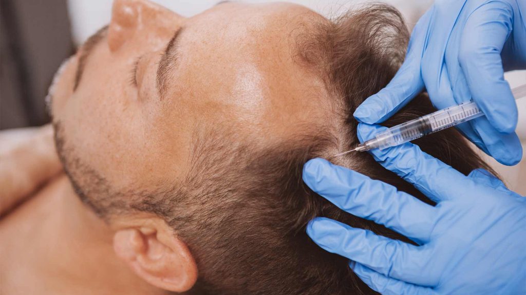 Prp treatment after hair transplantation