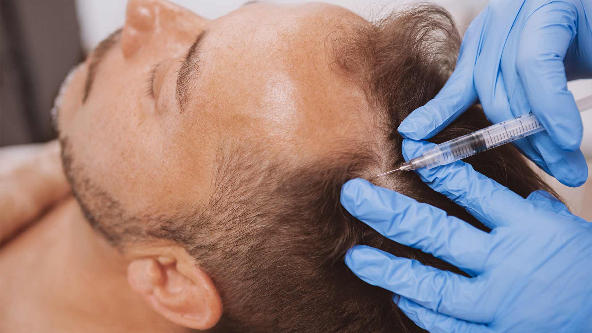 العلاج بالبلازما بعد زراعة الشعر